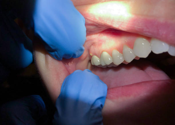Best Emergency Care for Gum Disease in Dansville, NY